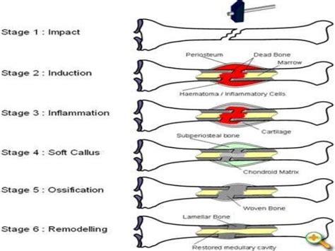 Fracture healing and factors affecting fracture healing