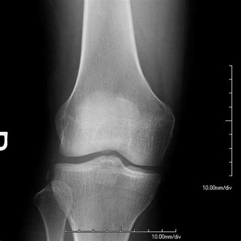 Proximal Tibial Fractures