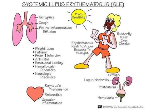 Lupus erythematosus, systemic; Libman-Sacks Disease; Lupus ...