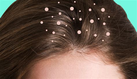 What Causes Dandruff? 10 Common Myths, Debunked | SELF