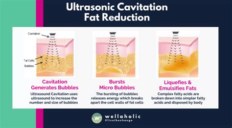 Don't believe the hype: An honest ultrasonic cavitation review