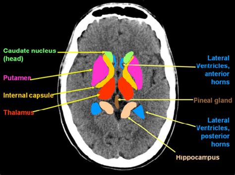 CT Scan Tips & Protocols: CT Brain anatomy