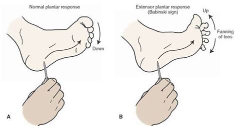 Reflex, babinski; Babinski Reflex; Extensor Plantar Response; Paradoxical Extensor Reflex, Great Toe