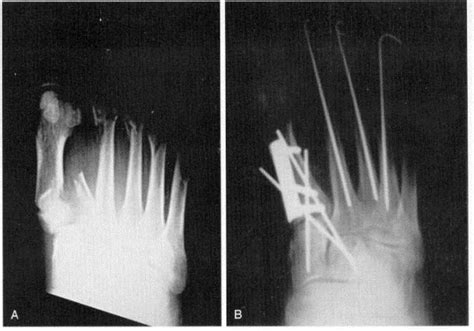 Metatarsal Bone Fracture