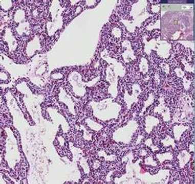 Histopathology Lung --Interstitial pneumonia - YouTube