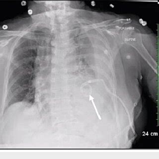 A). Anterior-posterior chest x-ray on admission showing a left-sided... | Download Scientific ...