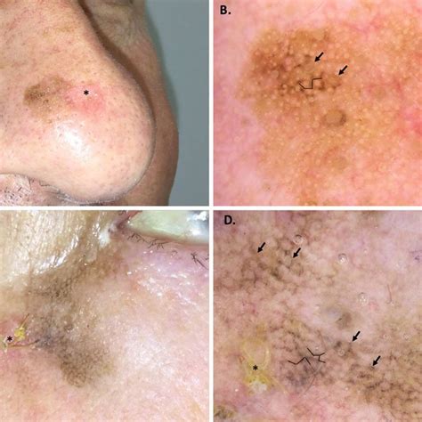 Melanoma dermoscopy progression model. (a) Asymmetric follicular... | Download Scientific Diagram