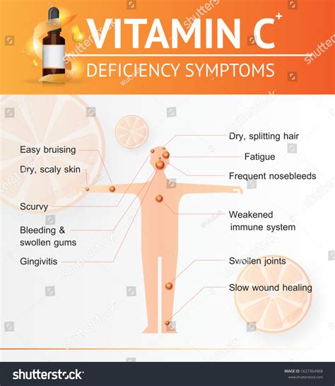 Monastery Deviate Marxist vitamin c deficiency symptoms nhs Partial ...