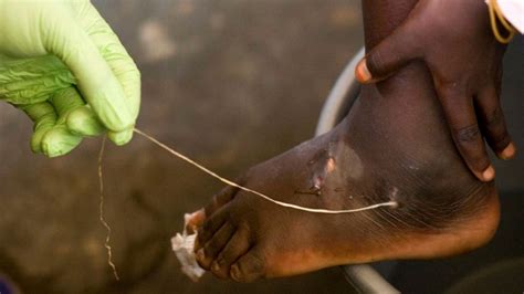 Ghana wins 23-year fight with Guinea worm disease | CTV News