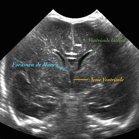 Échographie trans-fontanellaire (ETF) en coupe frontale passant par les ...