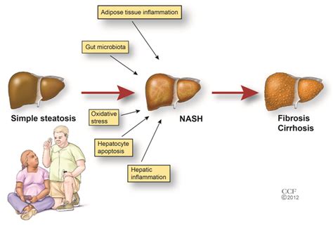 What Causes Nash Liver Disease - widevision2012