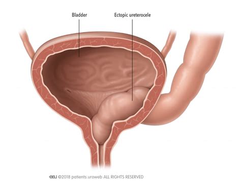 Congenital malformation in the urinary tract - Patient Information