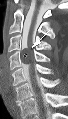 CT Myelography: Clinical Indications and Imaging Findings | RadioGraphics