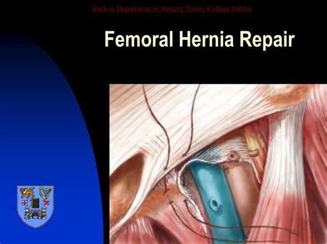 PPT - Abdominal Wall Hernia PowerPoint Presentation - ID:3094629