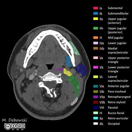 Lymph node levels of the neck | Radiology Reference Article ...