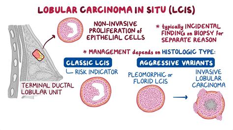 Lobular carcinoma in situ: Clinical sciences - Osmosis Video Library