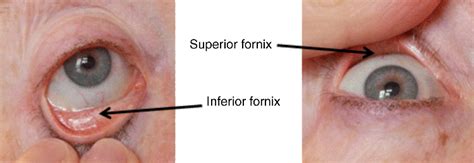 Anatomy of the Eye and the Role of Ocular Mucosa in Drug Delivery | Basicmedical Key