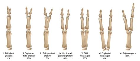 Preaxial Polydactyly | Obgyn Key