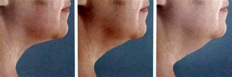 Thermage For Neck Before And After (1) » Facelift: Info, Prices, Photos, Reviews, Q&A