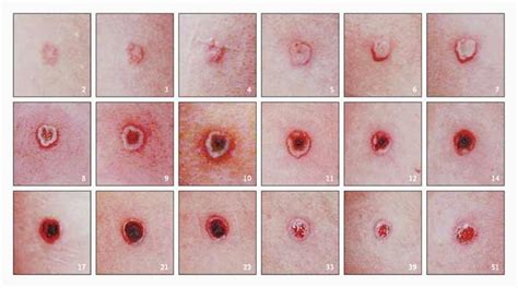 Progression of the Lesion at the Site of Inoculation after Smallpox ...