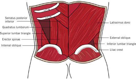 Lumbar Hernia