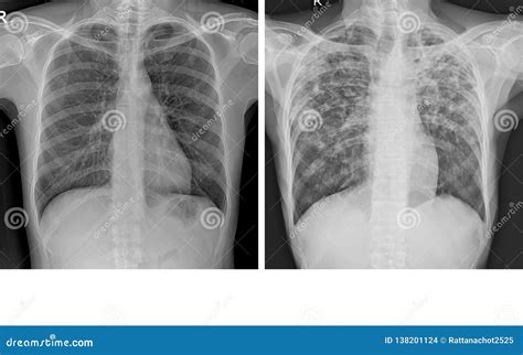 Tuberculosis Lung X Ray