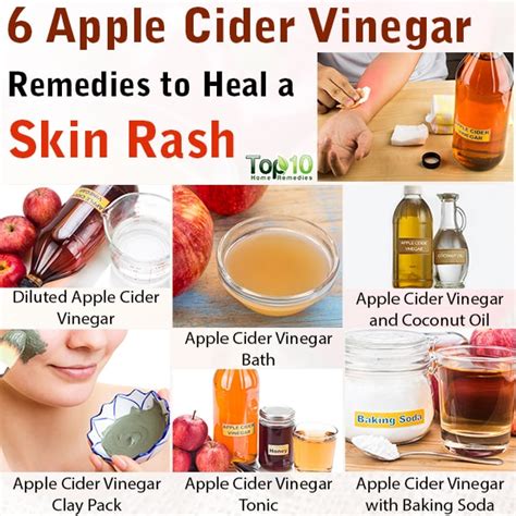 6 Apple Cider Vinegar Remedies to Heal a Skin Rash | Top 10 Home Remedies