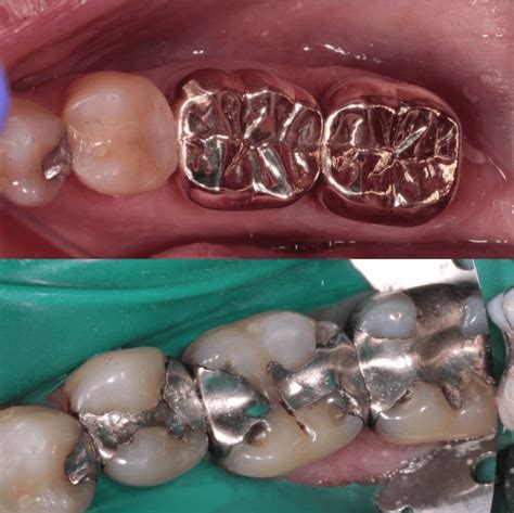 The 5 things you do not know about silver fillings (Amalgam ...