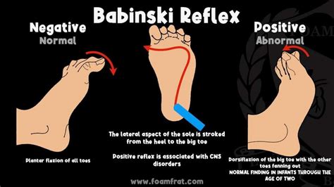 The Babinski Reflex 🦶 Also known as the plantar reflex is evoked when ...