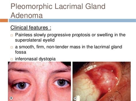 Lacrimal gland tumor