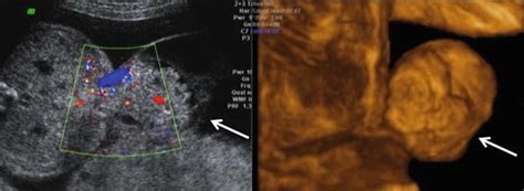 Prenatal Diagnosis of Beckwith-Wiedemann Syndrome Using 3D Ultrasound and Fetal MRI | Obgyn Key