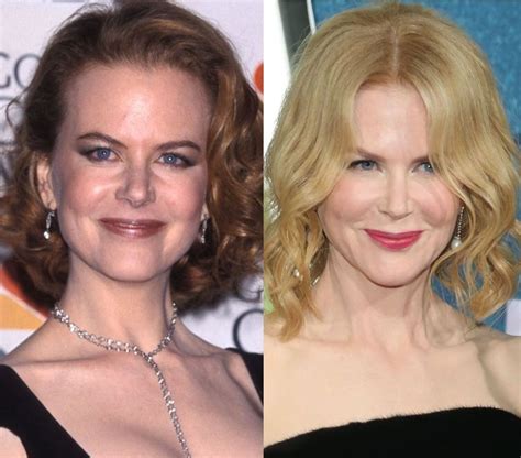 Nicole Kidman before and after plastic surgery (18) – Celebrity plastic ...