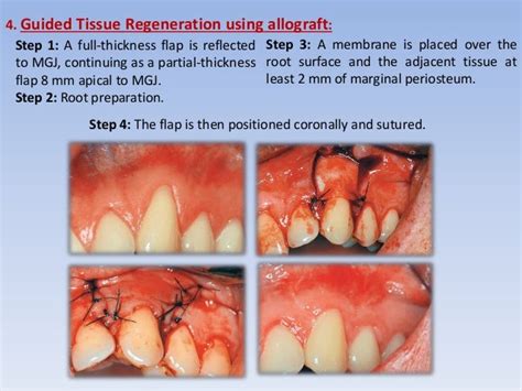 Mucogingival surgery