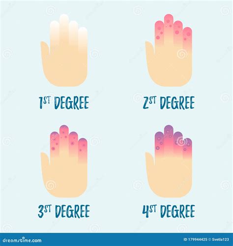 Frostbite Stages, Vector Cartoon Illustration Of Hands | CartoonDealer.com #207310481