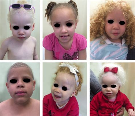 Wide phenotypic variation among children with oculocutaneous albinism.... | Download Scientific ...