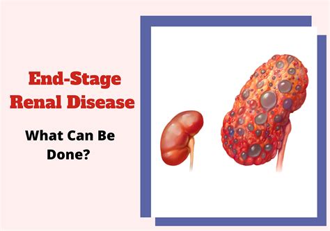 End-Stage Renal Disease (Kidney Disease) – What Can Be Done?