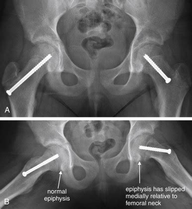 Pelvic Fracture X Ray