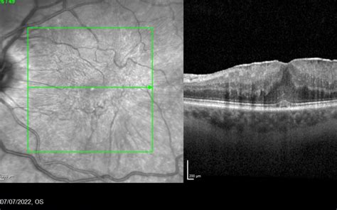 Epiretinal Membrane (ERM): Causes, Symptoms, and Treatment - Miss Anna Grabowska