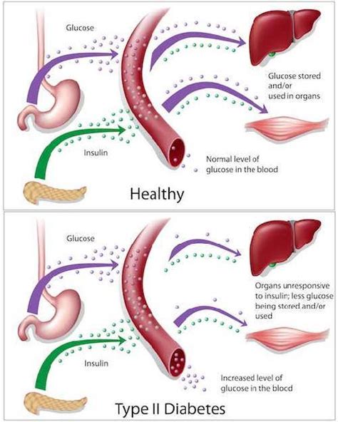 Diabetes Mellitus Type 2: Symptoms, Complications, and Treatment