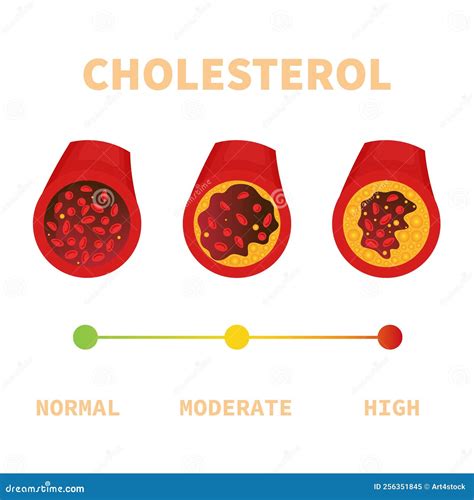 Cholesterol Plaque in Blood Vessel Medical Diagram Stock Vector ...