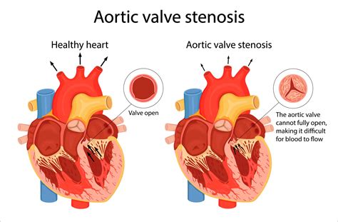 Aortic Stenosis: Exploring a Critical Heart Condition | Add More to Lives