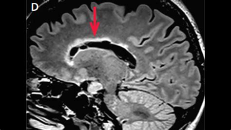 Corpus Callosum Lesions - The Neurology Hub