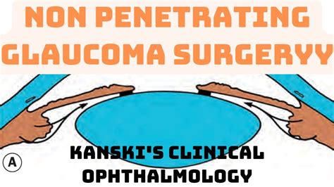 Non-penetrating glaucoma surgery-Kanski's clinical ophthalmology #eye ...