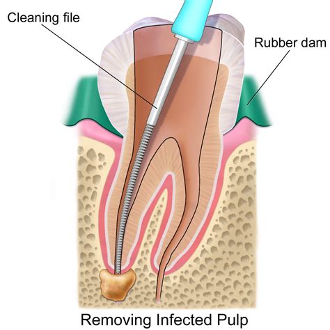 Root Canal Therapy at Roy | Lakeview Dental