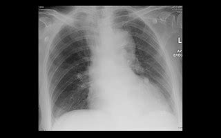 Aortic dissection without mediastinal haemorrhage, CXR (1/… | Flickr