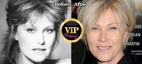 Deborra Lee Furness Plastic Surgery Before And After