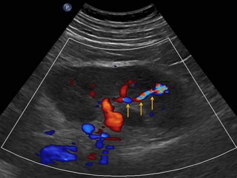 arteriovenöse Fistel der Niere | pacs