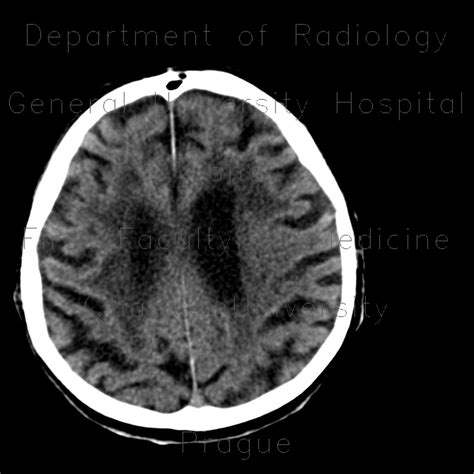 Radiology case: Leukoaraiosis