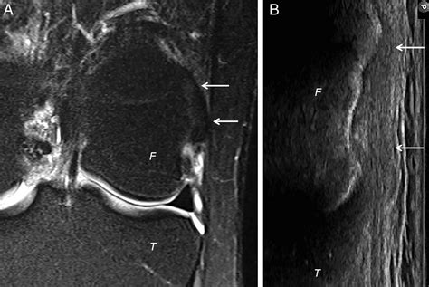 Imaging Characteristics of the Proximal Lateral Collateral Ligament of ...