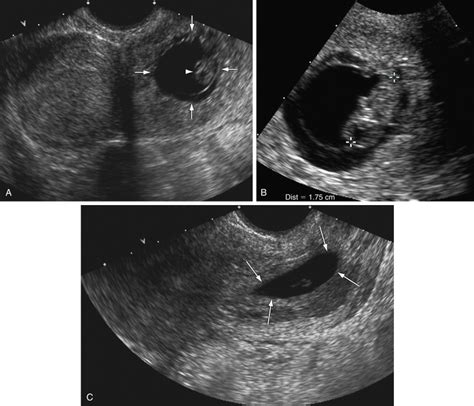 Cervical Ectopic Pregnancy